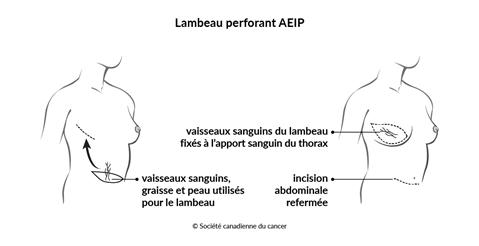 Schéma d'un lambeau perforant AEIP