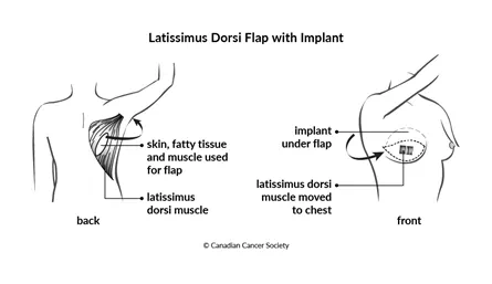 Diagram of a latissimus dorsi flap with implant