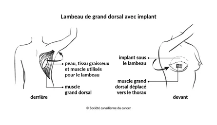 Schéma d'un lambeau de grand dorsal avec implant