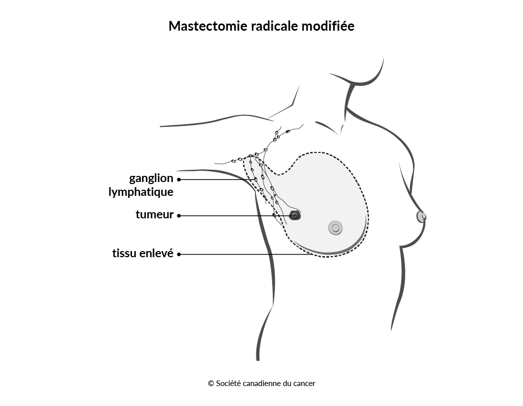 Schéma de la mastectomie radicale modifiée