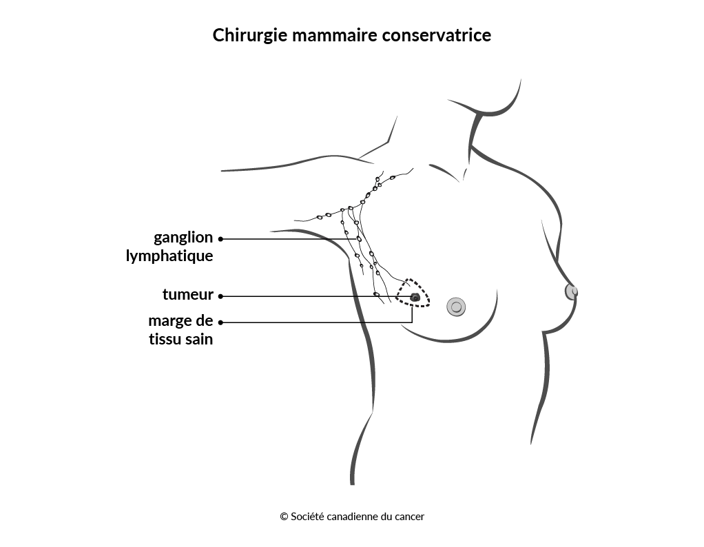 Schéma de la chirurgie mammaire conservatrice