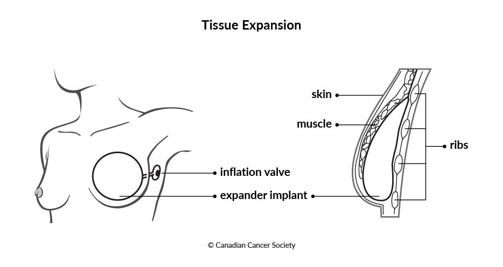 Diagram of tissue expansion