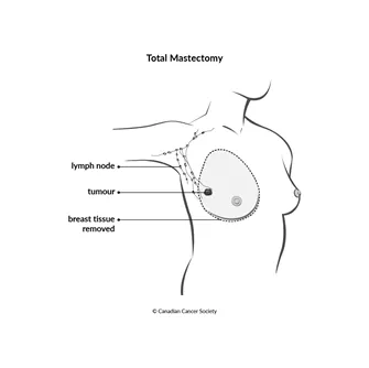 Diagram of total mastectomy