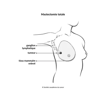 Schéma de la mastectomie totale