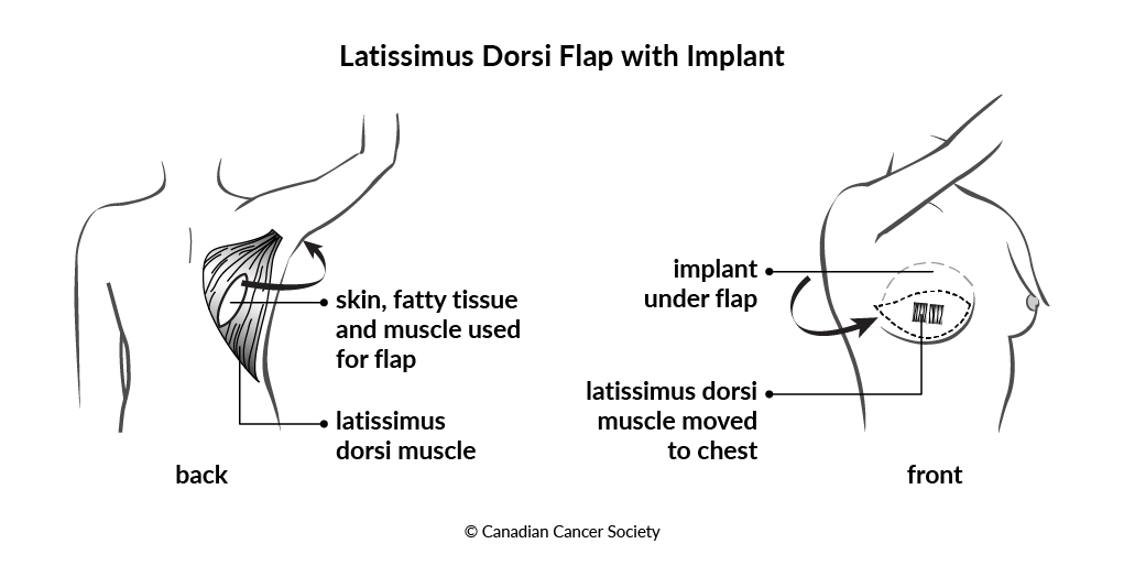 Diagram of a latissimus dorsi flap with implant