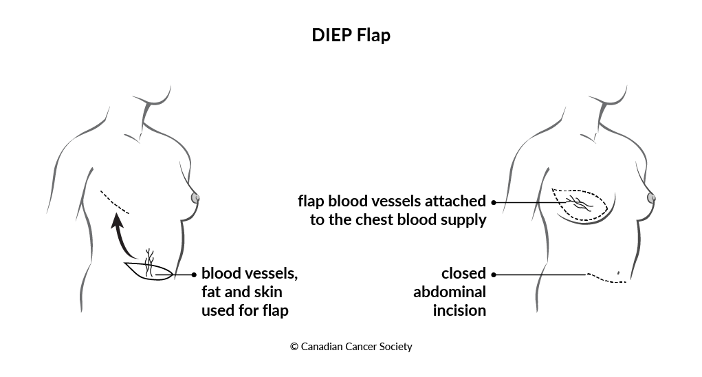 Diagram of a DIEP flap