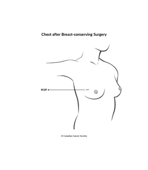Diagram of chest after breast-conserving surgery