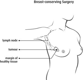 Diagram of breast conserving surgery