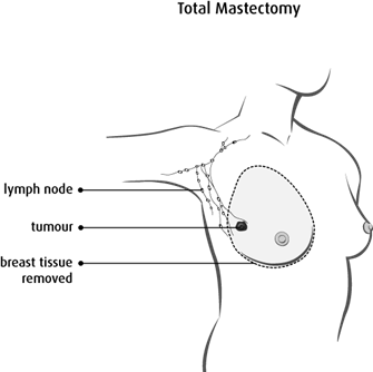 Diagram of a total mastectomy