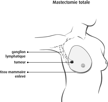 Schéma de la mastectomie totale