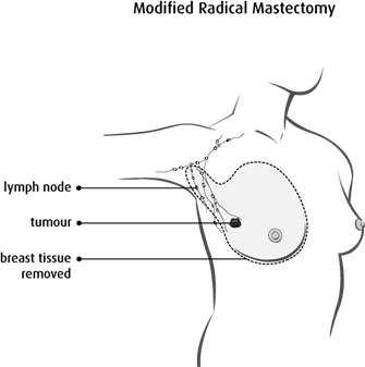 Diagram of a modified radical mastectomy