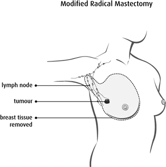 Diagram of a modified radical mastectomy
