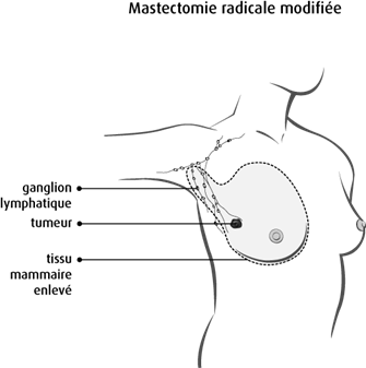 Schéma de la mastectomie radicale modifiée