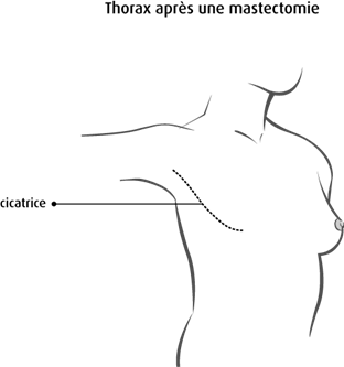 Schéma du thorax après une mastectomie