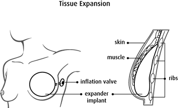 Diagram of tissue expansion