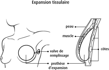 Schéma de l'expansion tissulaire