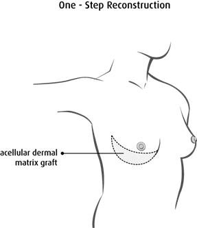 Diagram of one step reconstruction