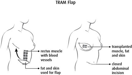 diagram of a TRAM flap
