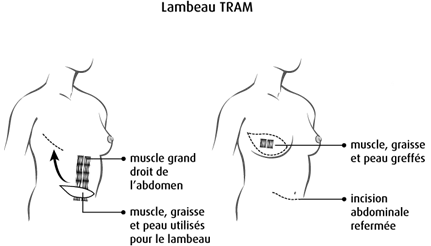 schéma d'un lambeau TRAM