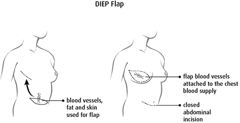 diagram of a DIEP flap