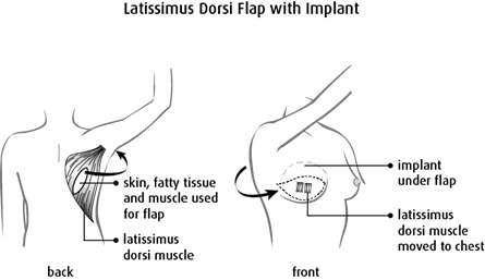 diagram of a latissimus dorsi flap with implant