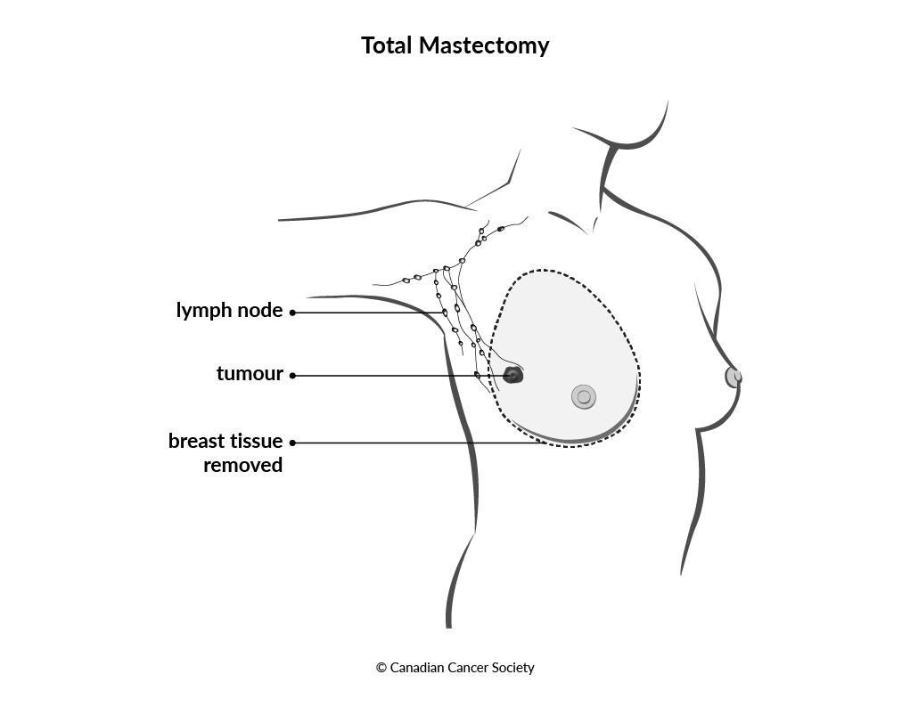 Diagram of total mastectomy
