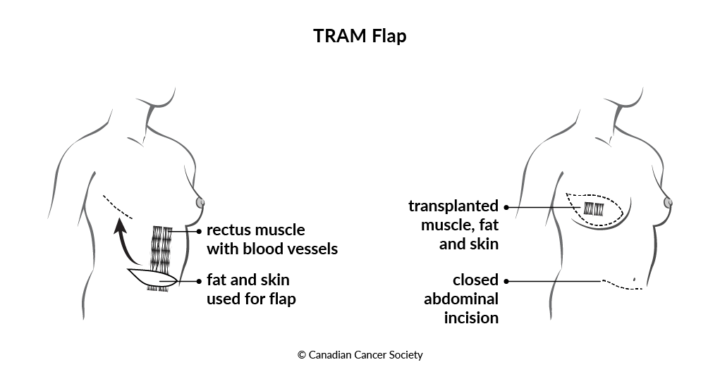 Diagram of a TRAM flap