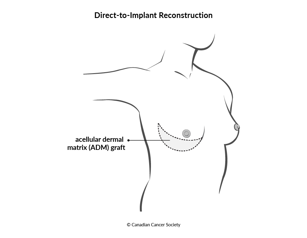 Diagram of direct-to-implant reconstruction