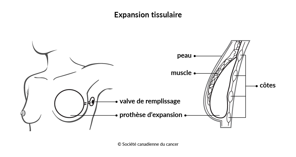 Schéma de l’expansion tissulaire