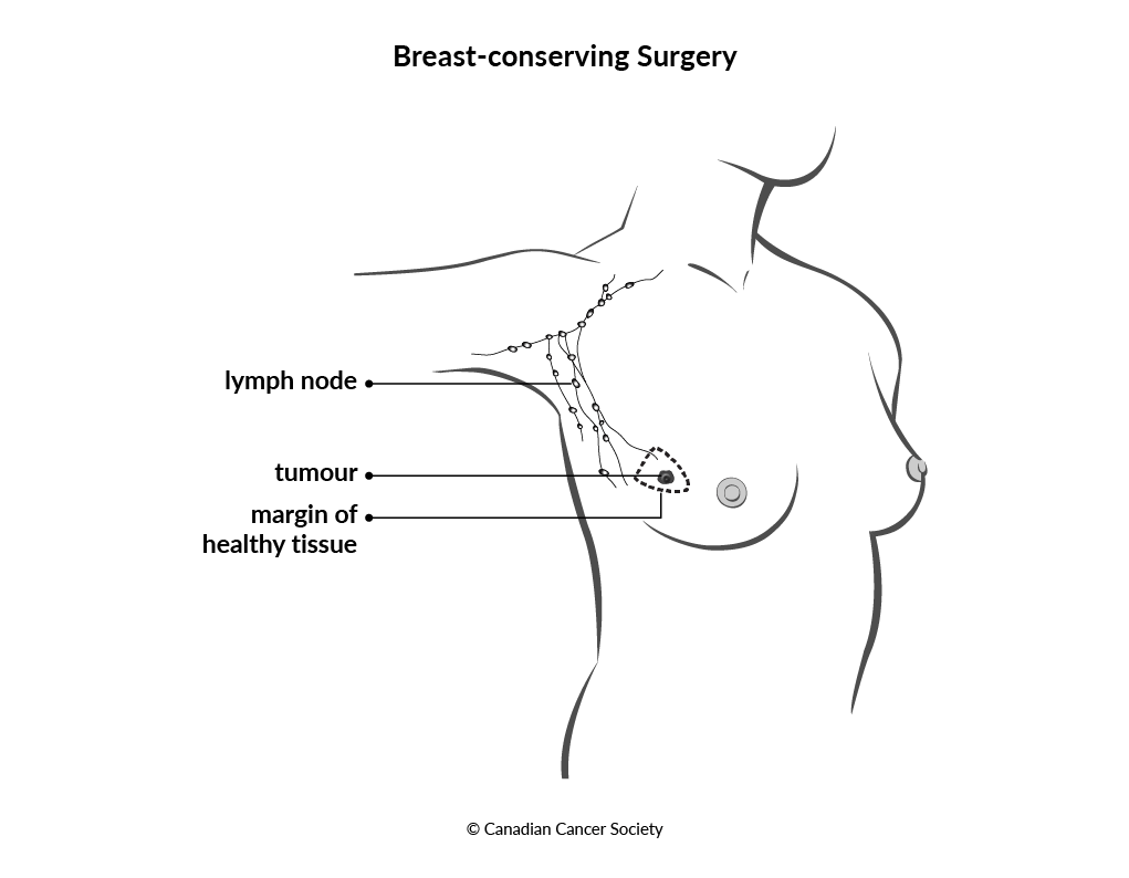 Diagram of breast-conserving surgery