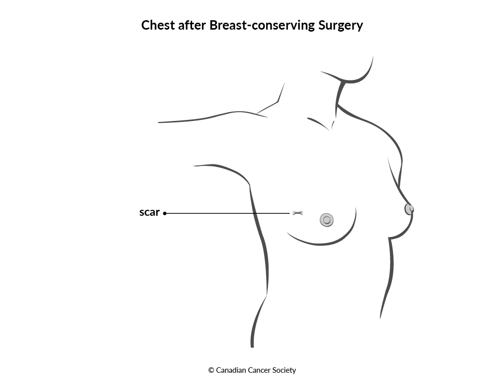 Diagram of chest after breast-conserving surgery