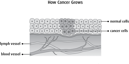Diagram of how cancer grows