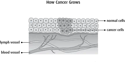 Diagram of how cancer grows