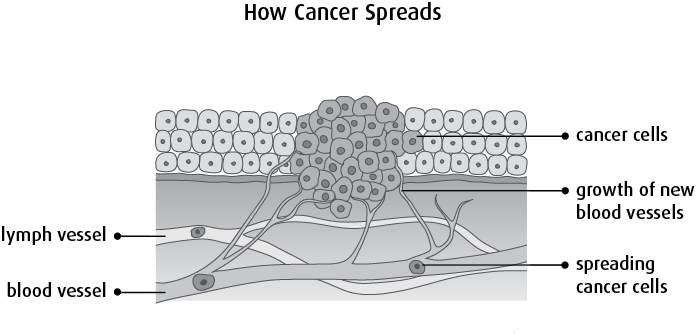 3 ways cancer can spread        
        <figure class=