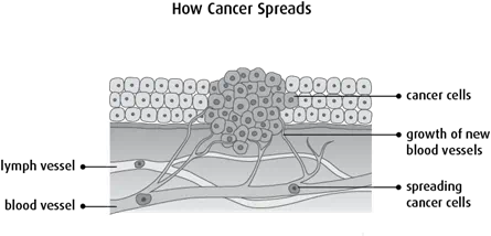 Diagram of how cancer spreads