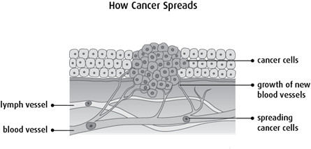 Diagram of how cancer spreads
