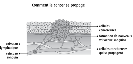 Schéma de la façon dont le cancer se propage