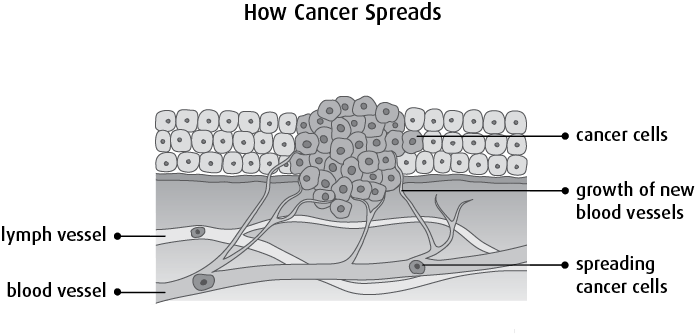 Diagram of how cancer spreads