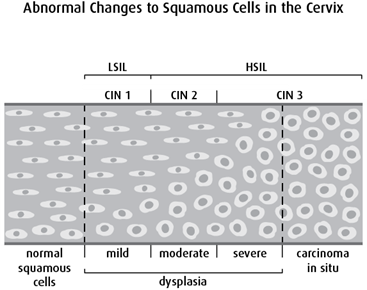 Diagram of abnormal changes to squamous cells in the cervix