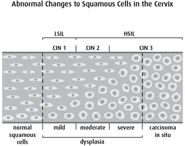 Diagram of abnormal changes to squamous cells in the cervix