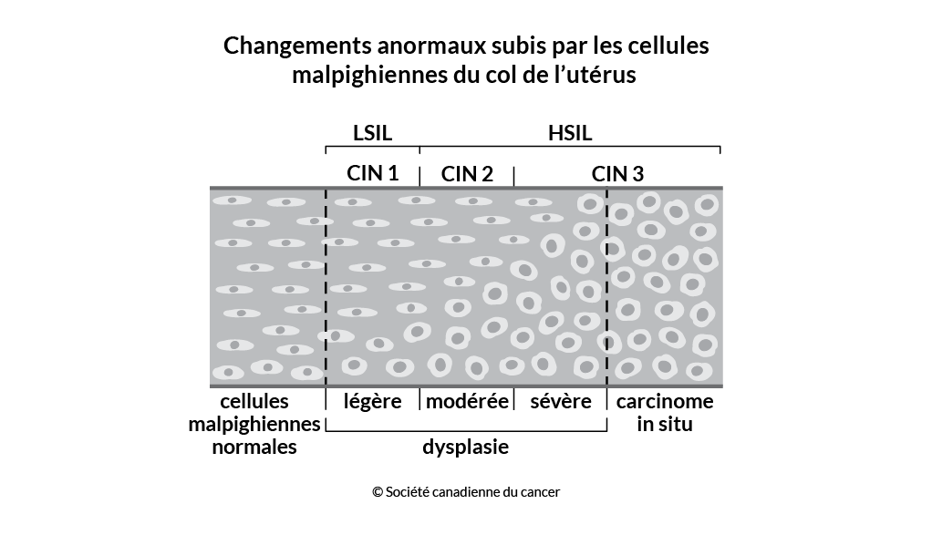 Schéma des changements anormaux subis par les cellules malpighiennes du
                    col de l'utérus