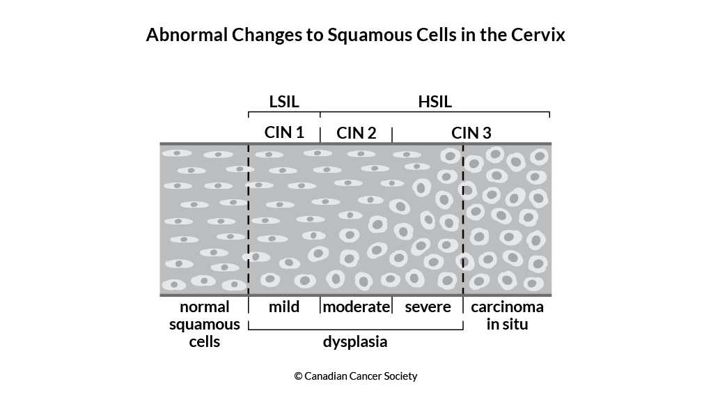 Diagram of abnormal changes to squamous cells in the cervix