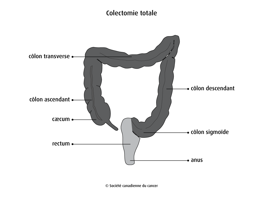 Schéma de la colectomie totale