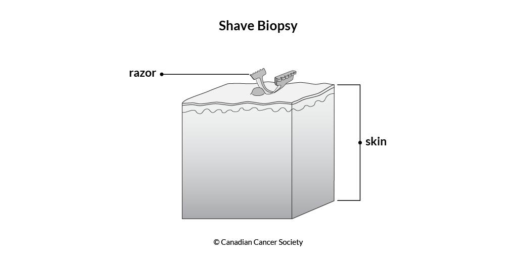 Diagram of a shave biopsy