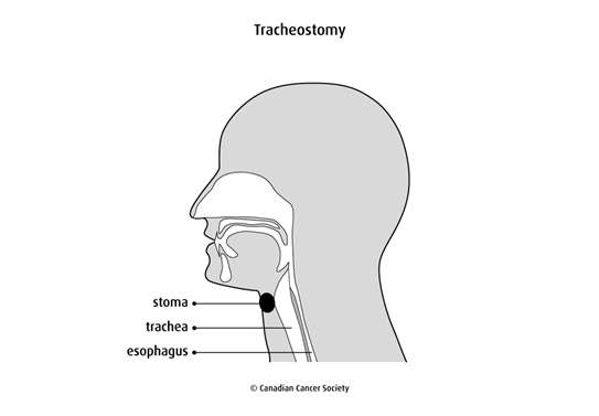 Diagram of a tracheostomy