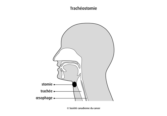 Schéma de la trachéostomie