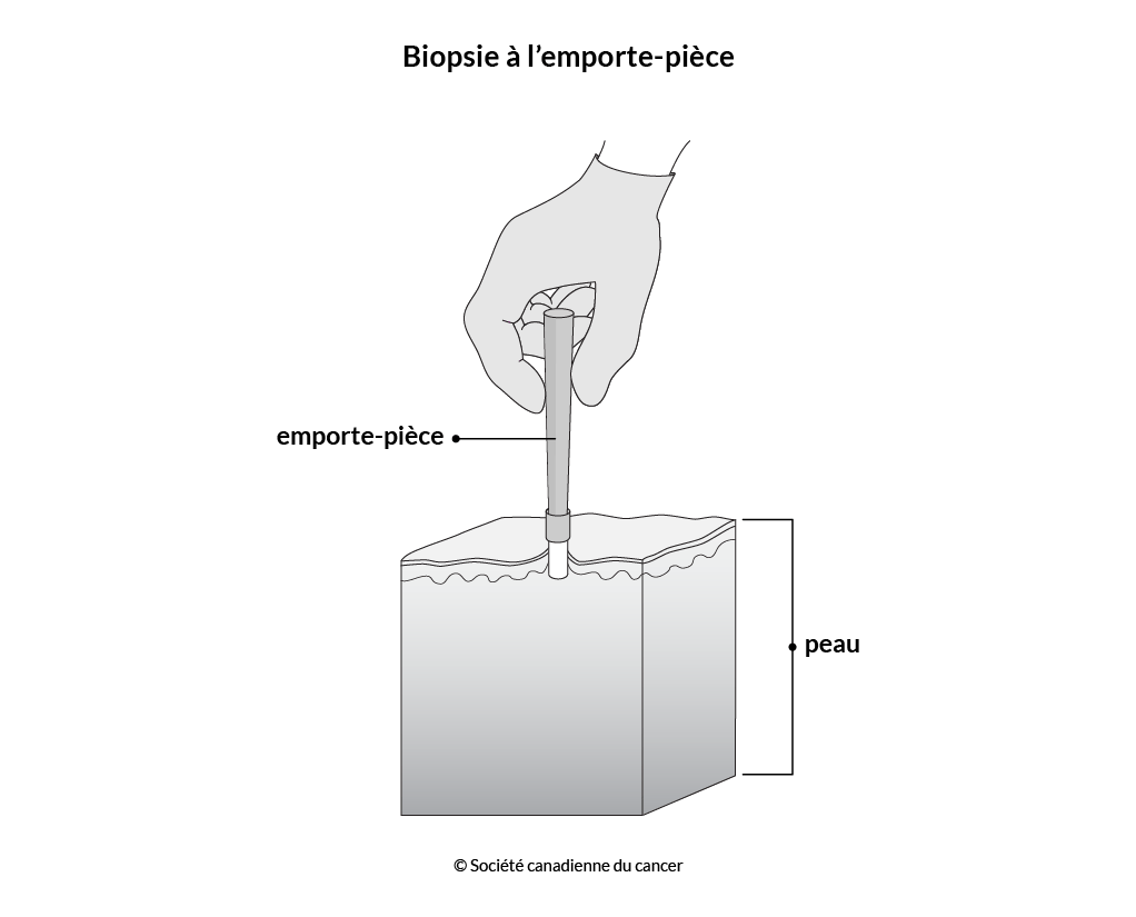 Schéma de la biopsie à l’emporte-pièce