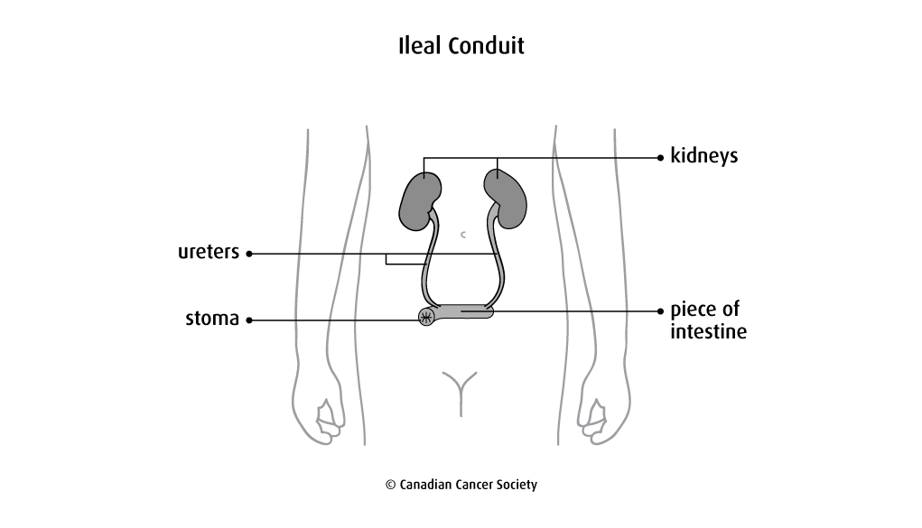 Diagram of an ileal conduit