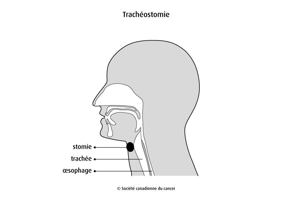 Schéma de la trachéostomie