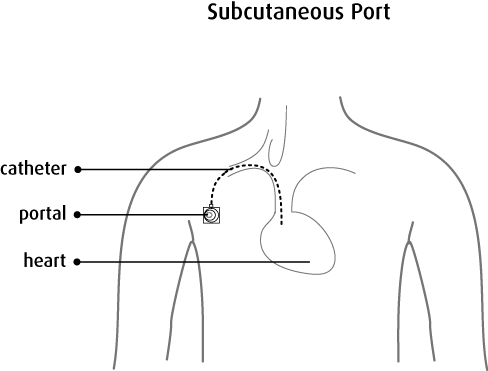 Subcutaneous Port